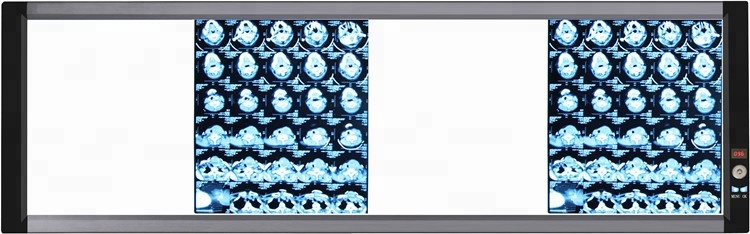 High quality Triple LED x ray film viewing box medical negatoscope