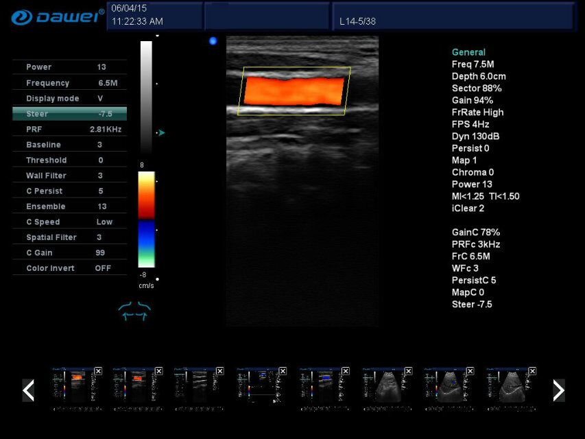 Portable doppler Ultrasound Machine Laptop color ultrasound Machine