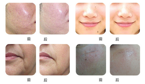 New style skin renew equipment of co2 fractional laser/co2 laser equipment