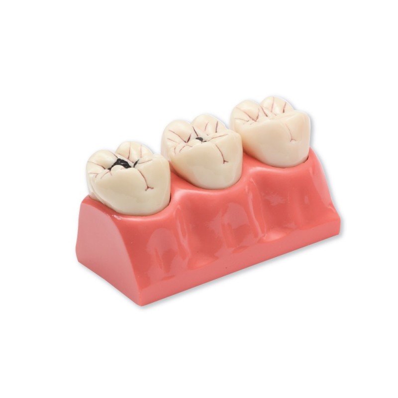 caries dental