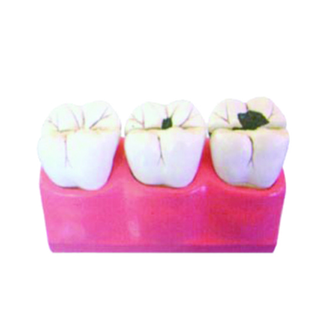 Dental Study Tooth Caries Model