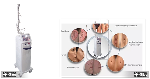 The latest technology from China of vaginal tightening machine/co2 fractionnal laser/laser beauty machine